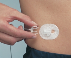 Silhouette 43" 17 mm Infusion Set